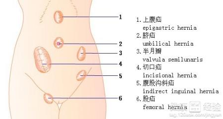 小兒疝氣有哪些症狀