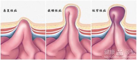 小兒疝氣做手術後注意事項