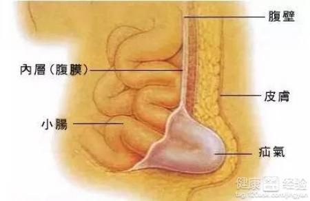 小兒疝氣手術後吃什麼好