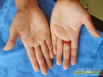手足口病疱疹搽什麼藥