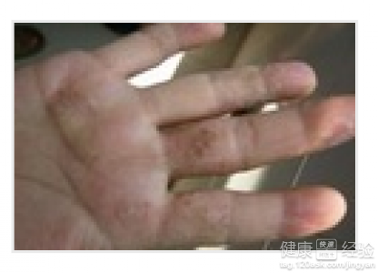 手足口病疱疹會癢嗎