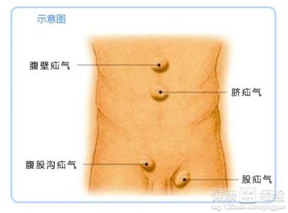 用什麼中藥可以治療小兒疝氣