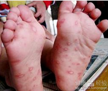 水痘與手足口病有什麼區別