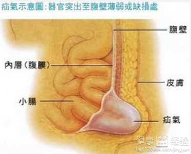 小兒疝氣都適合做手術治療嗎