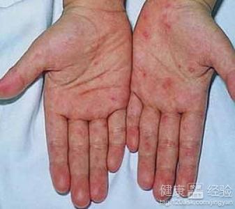 手足口病前期症狀有哪些表現