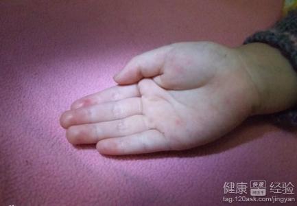 幼兒手足口病初期症狀有哪些表現