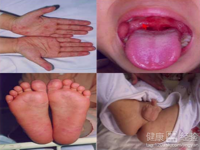 寶寶手足口病症狀表現有哪些