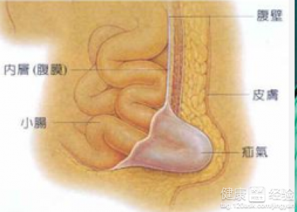 小兒疝氣何時手術最安全