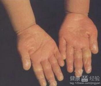 手足口病常見多發傳染源有哪些