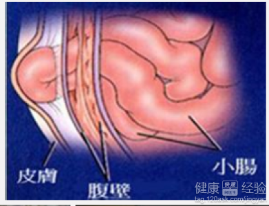 小兒疝氣再經索上手術有危險嗎