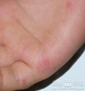 不發燒手上有疱疹是手足口病嗎