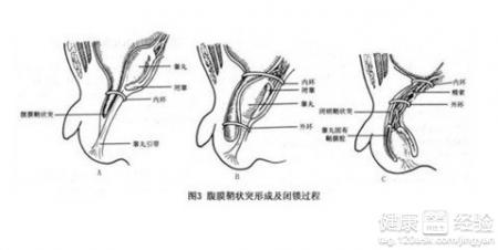 小兒疝氣手術後18天傷口可以長好嗎