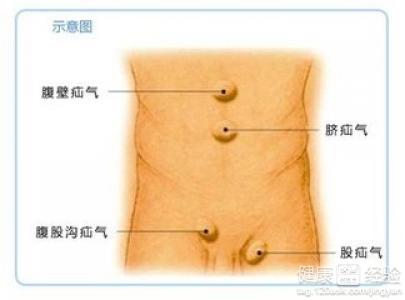 小兒疝氣陰囊有問題怎麼辦