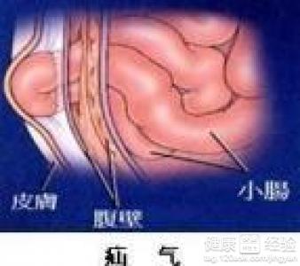 小兒疝氣保守治療方法有哪些