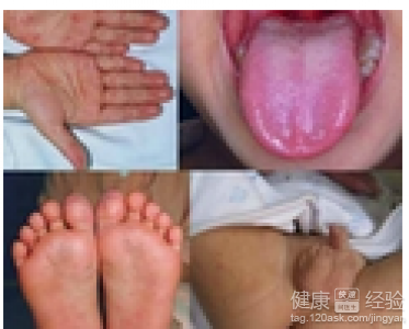小孩除了不發燒別的症狀都有是手足口病嗎