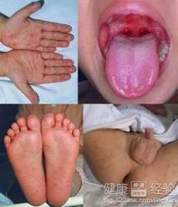 手足口病的臨床症狀有哪些