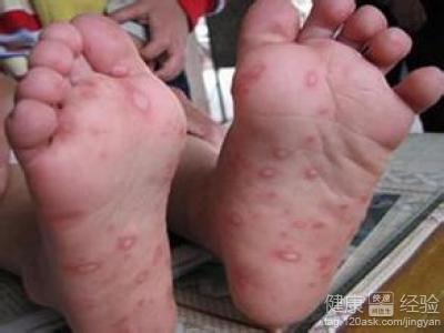 口裡面有白的手腳沒有疱疹是不是手足口病