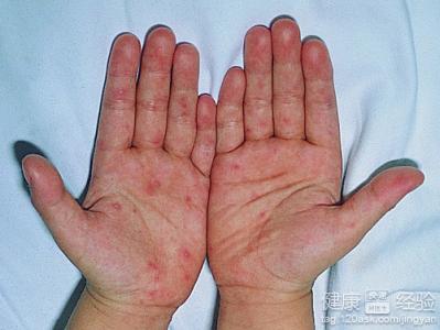 手足口病能用什麼藥預防