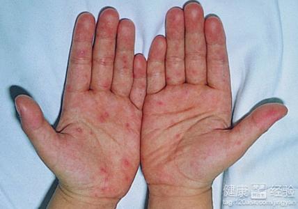 感冒發燒咳嗽會是手足口病嗎