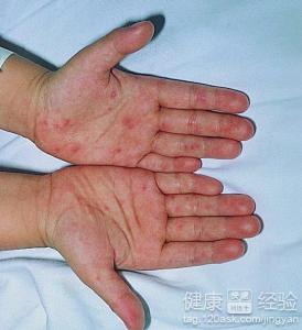 手足口病是持續發燒還是間隔發燒