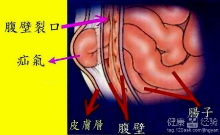 小兒疝氣什麽時候手術最好