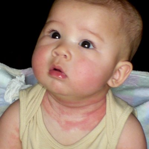 幼兒急疹出疹後注意事項  幼兒急診傳染嗎