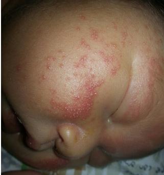 小寶寶應該怎麼預防和清胎毒？