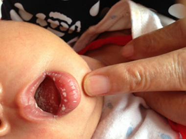 寶寶嘴裡面長了好多白泡泡怎麼回事