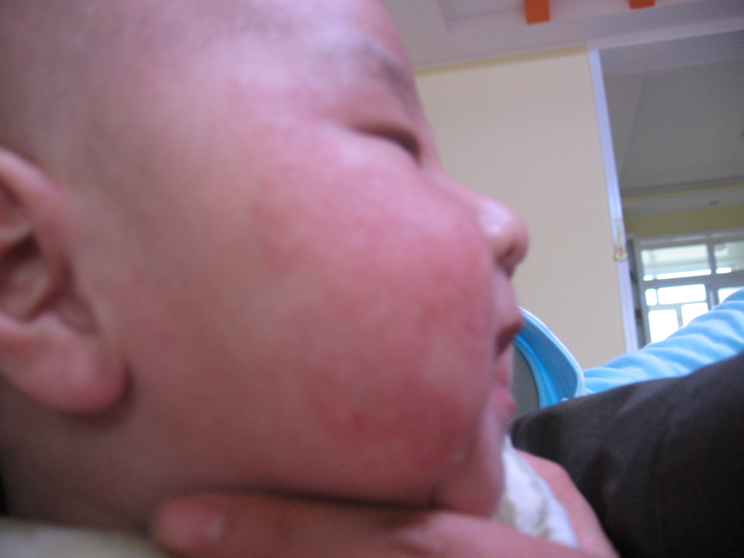 嬰兒濕疹症狀 嬰兒濕疹症狀（圖片）