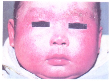 嬰兒濕疹圖片 嬰兒濕疹症狀圖片