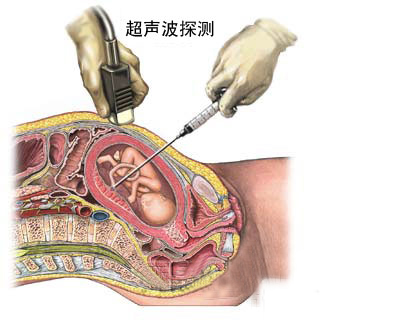 下面是胎兒臍帶血取樣圖文介紹