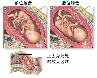 下面是胎兒臍帶血取樣圖文介紹