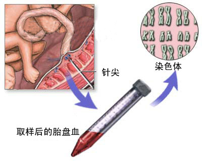 下面是胎兒臍帶血取樣圖文介紹