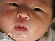 嬰兒濕疹的症狀（圖片）